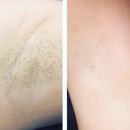 laser hair removal at la bella beauty salon Gloucestershire laser hair removal at la bella beauty salon Gloucestershire