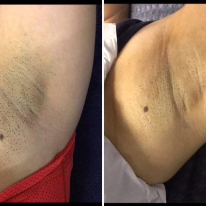 laser hair removal near me laser hair removal near me