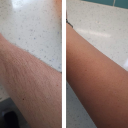 laser hair removal near me Gloucester laser hair removal near me Gloucester